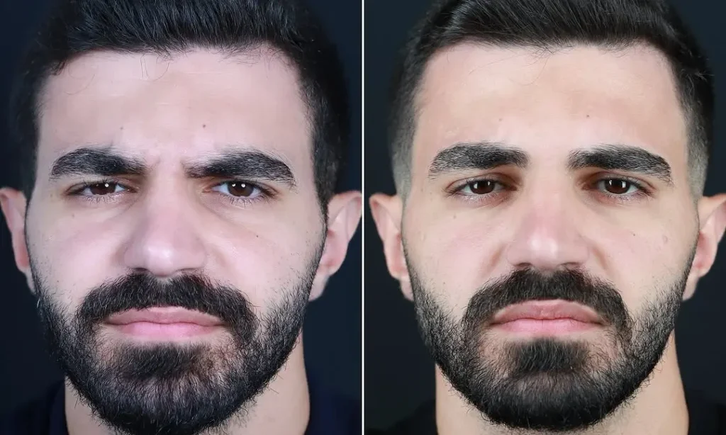 determining the best botox brand