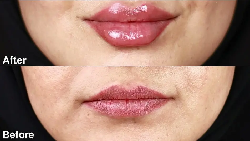 Lip Fillers Before and After Results