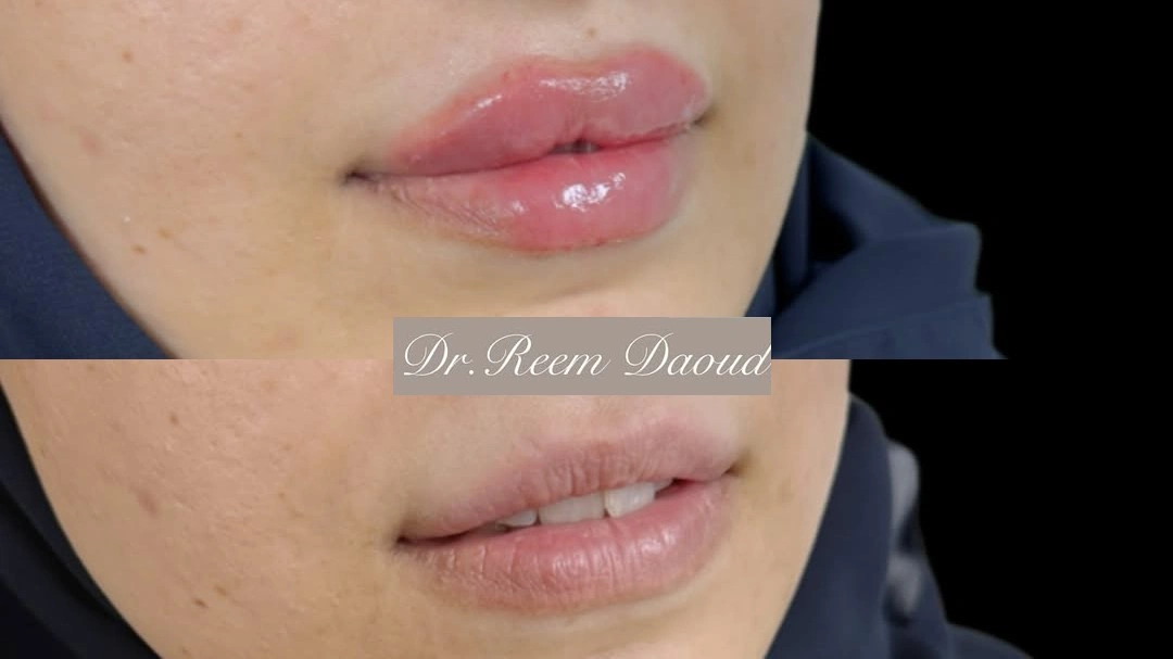 lip fillers near me