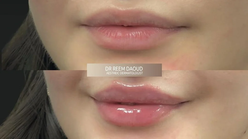 lip fillers results